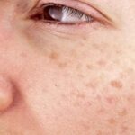 Microneedling visage et cou PM